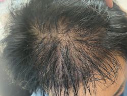 -碧莲盛·不剃发植发