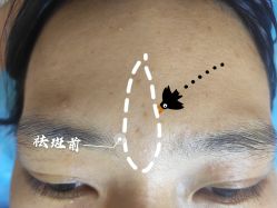 -爱莎扁平疣·汗管瘤·斑痣中心