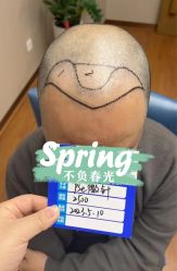 -大麦微针植发全国连锁