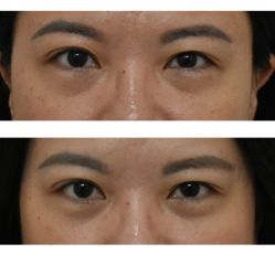 -广州健丽·去眼袋医疗美容机构