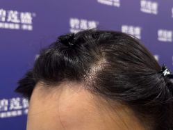 -碧莲盛·不剃发植发