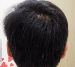 -大麦微针植发丨全国连锁