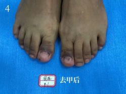 -德哥灰指甲脚气甲沟炎跖疣护理