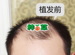 -大麦微针植发全国连锁