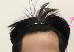 -大麦微针植发全国连锁