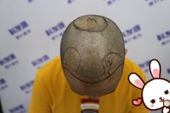 点击看大图 -大麦微针植发丨全国连锁