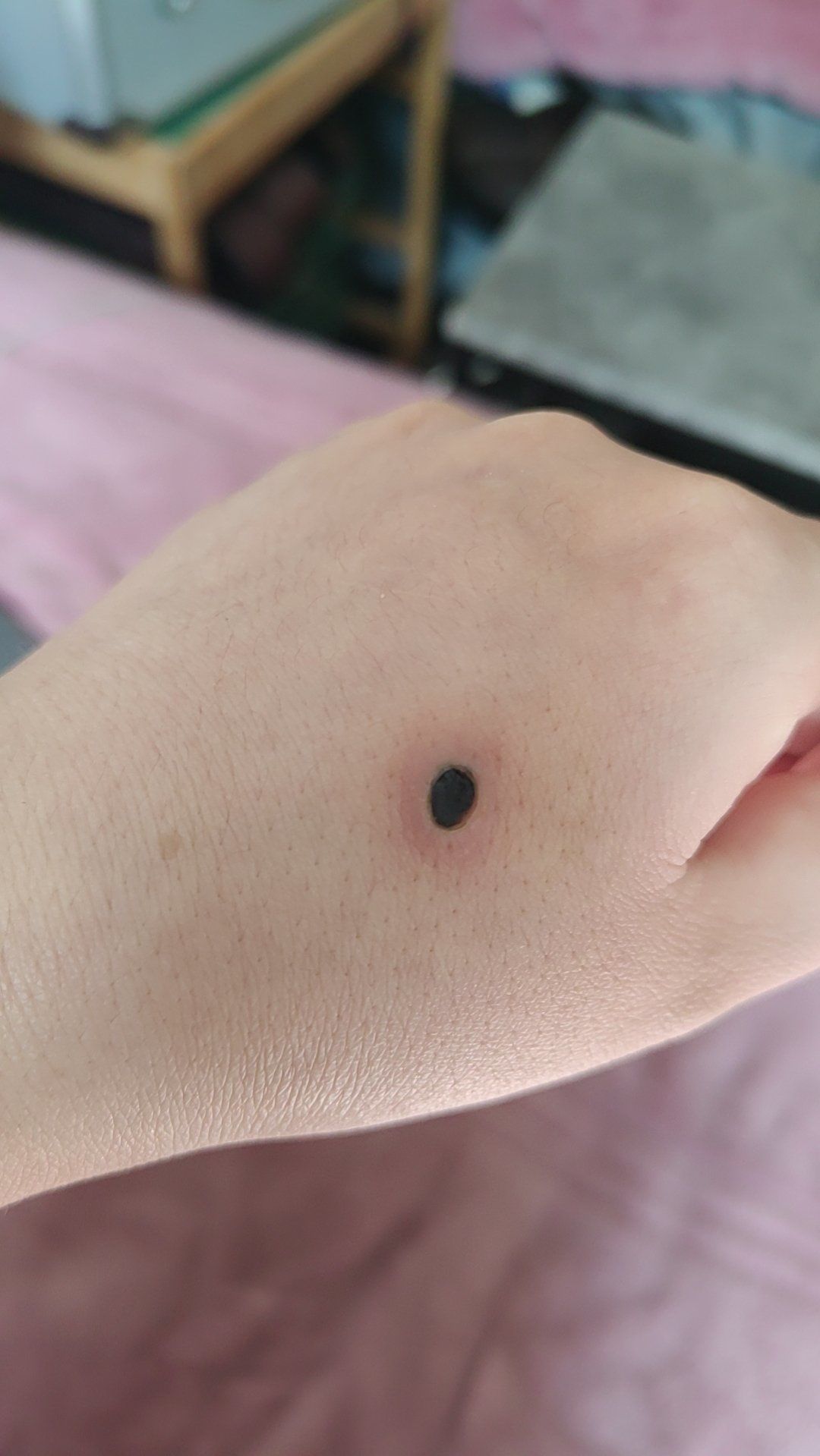 人为什么会长痦子