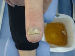 -Andrew指甲专科灰指甲·甲沟炎矫正·3D步态矫形鞋垫定制(浦三路店)