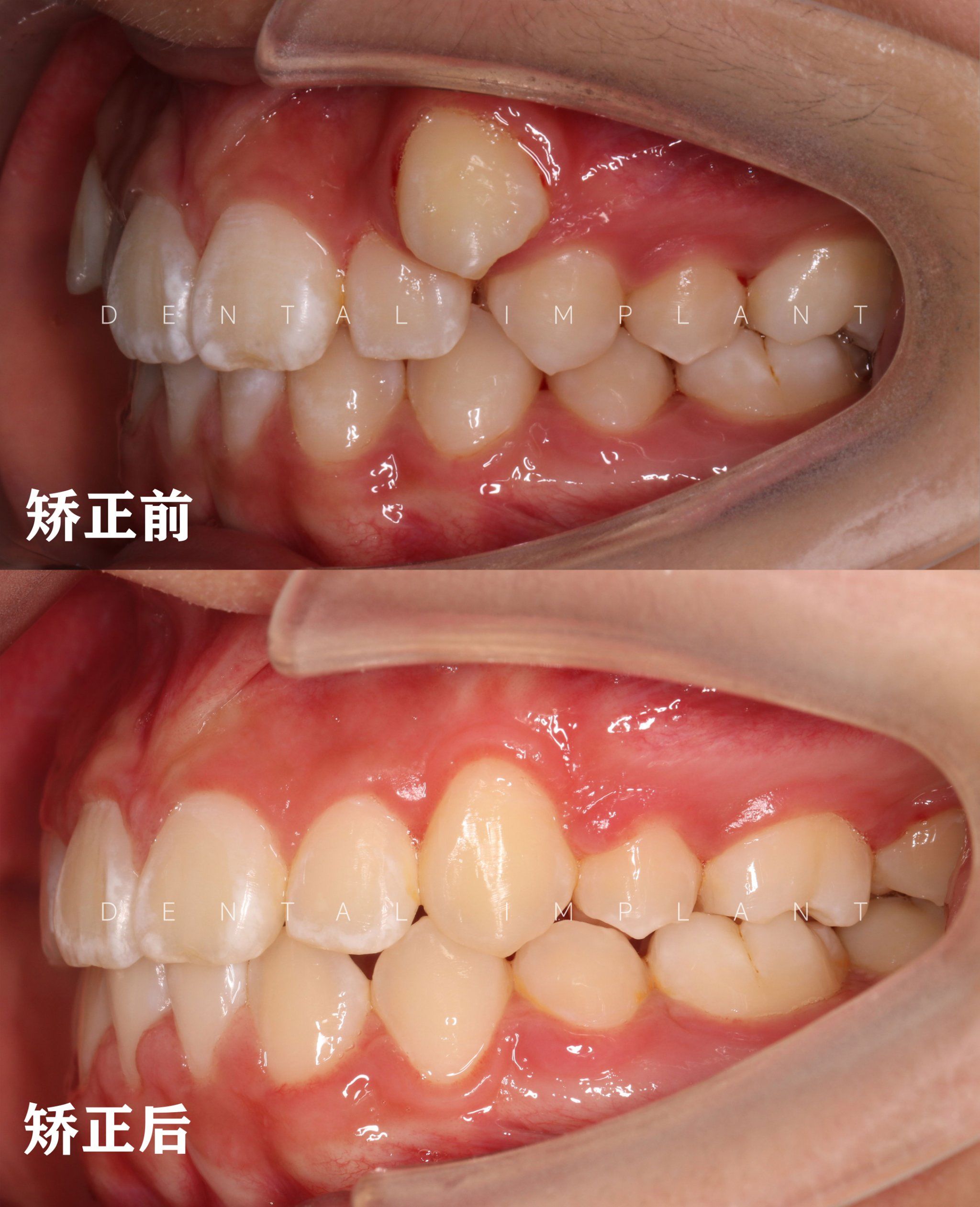 再见小尖牙,虎牙矫正结束啦~69