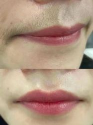 -薇兰专业脱毛连锁机构