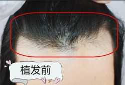 -大麦微针植发全国连锁