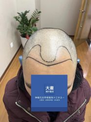 -大麦微针植发全国连锁