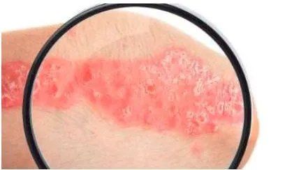 皮肤炎症的症状