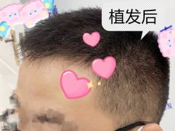 -大麦微针植发全国连锁