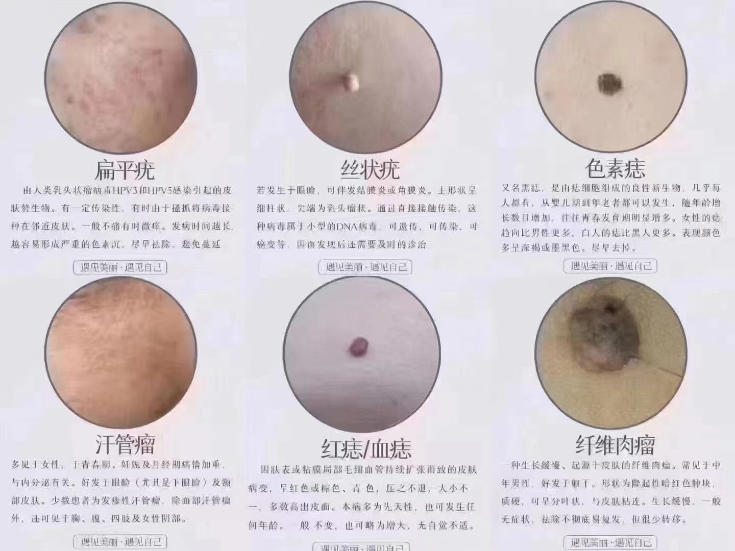 疣会传染吗?