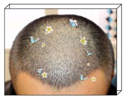 -大麦微针植发全国连锁