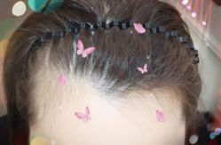 -大麦微针植发全国连锁