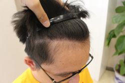 -大麦微针植发丨全国连锁