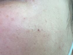 体验后-正璞医疗美容·皮肤修复·微整注射