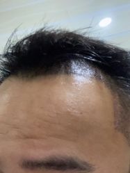 体验后-大麦微针植发全国连锁