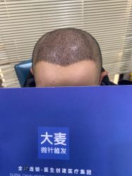 -大麦微针植发丨全国连锁