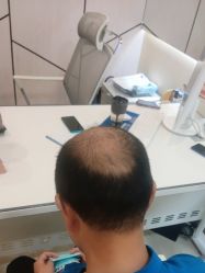 -碧莲盛·不剃发植发