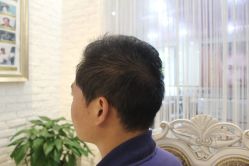 点击看大图 -大麦微针植发丨全国连锁