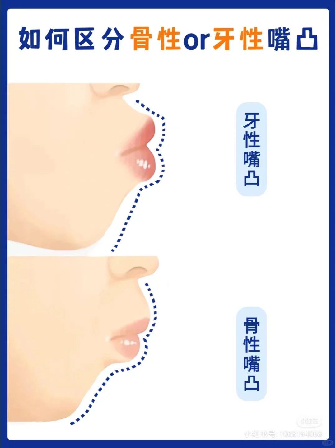如何判断时骨性or牙性嘴凸71想变美别搞错75