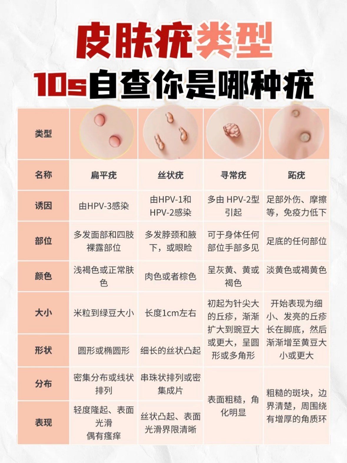 科普各类疣和如何去除疣