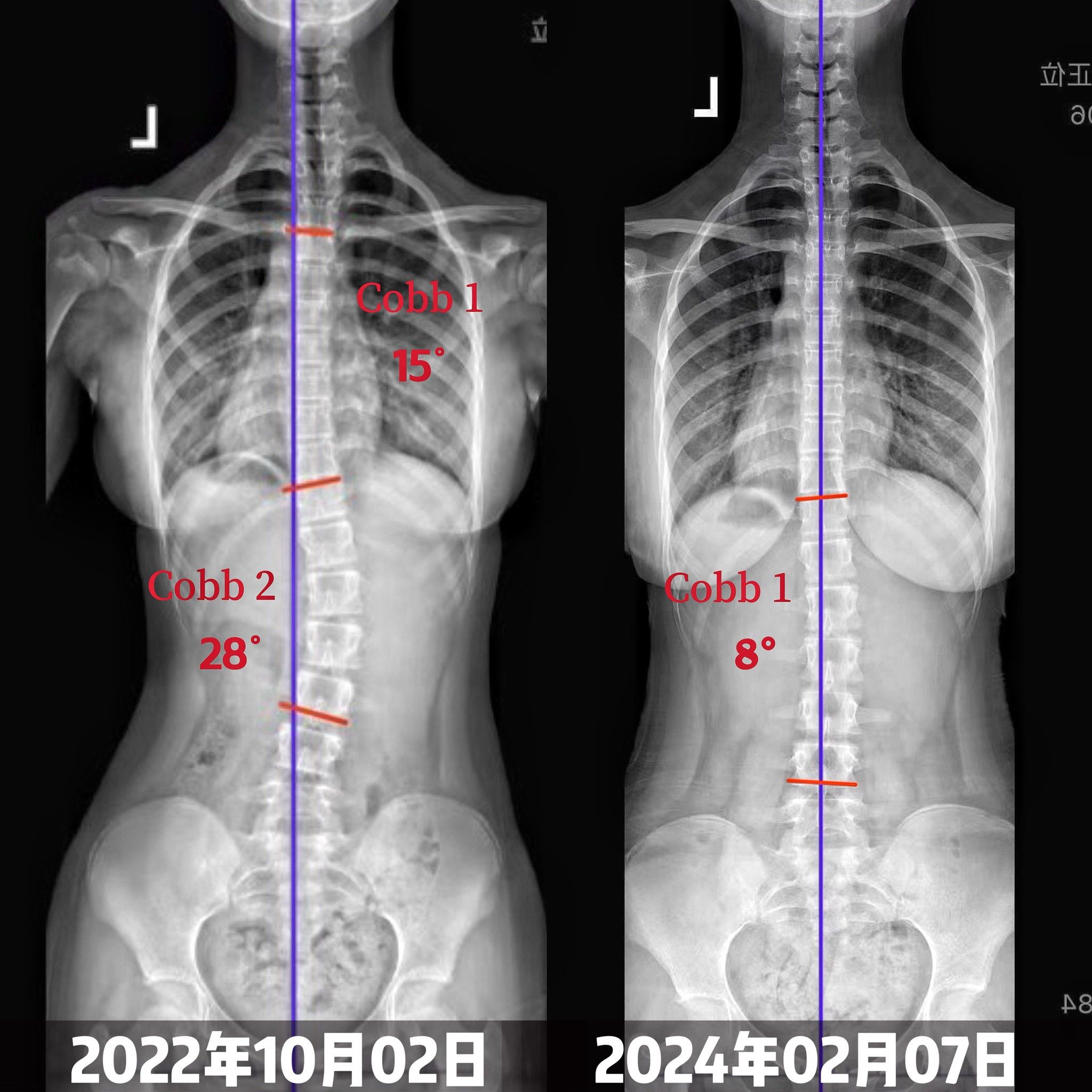 成长轨迹:骨骼x光对比
