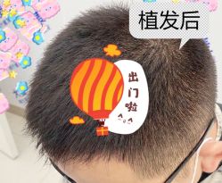 -大麦微针植发全国连锁