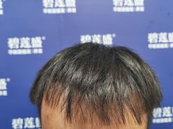 -碧莲盛·不剃发植发