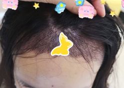 -大麦微针植发全国连锁