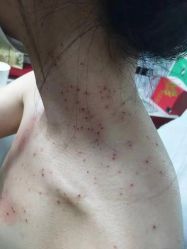 -北京美痣堂古方祛痣斑疣瘊