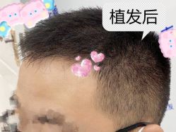 -大麦微针植发全国连锁