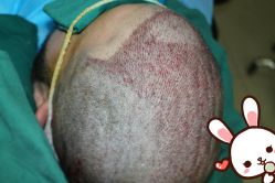 点击看大图 -大麦微针植发丨全国连锁