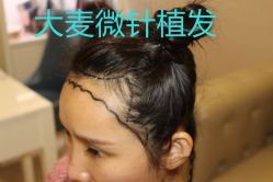 -大麦微针植发丨全国连锁