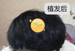 -大麦微针植发全国连锁