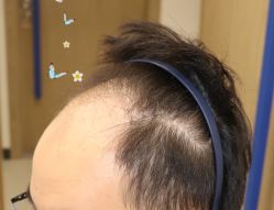 -大麦微针植发全国连锁