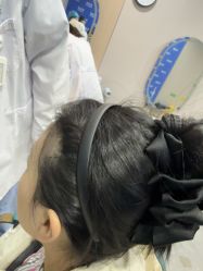 -碧莲盛不剃发植发