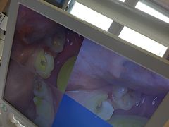 -上海仁爱医院口腔科 · 种植