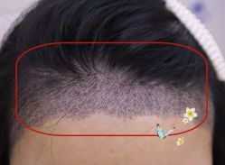 -大麦微针植发全国连锁