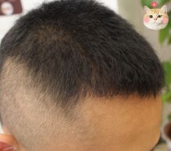 -大麦微针植发丨全国连锁