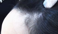 -雍禾植发全国连锁