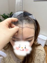 -大麦微针植发全国连锁