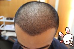 -大麦微针植发丨全国连锁