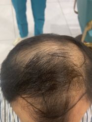 -碧莲盛不剃发植发