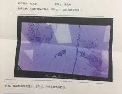 -派恩宜灰指甲鸡眼嵌甲手足癣