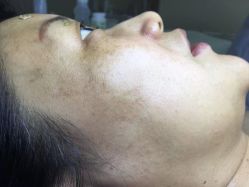 -爱莎扁平疣·汗管瘤·斑痣中心