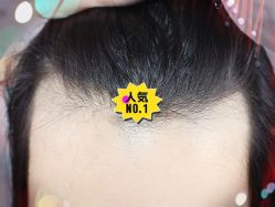 -大麦微针植发全国连锁